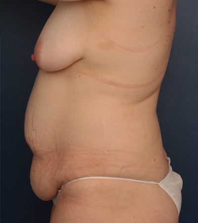 Before Image: Tummy Tuck - left-side