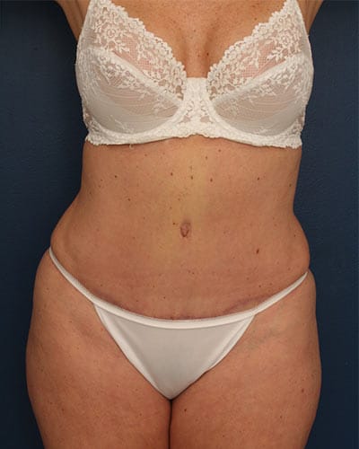 After Image: Tummy Tuck - front