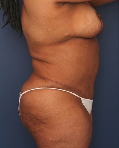 After Image: Tummy Tuck - right-side