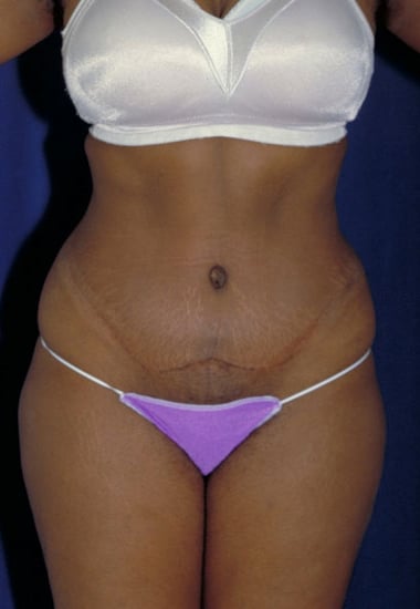 After Image: Tummy Tuck - front