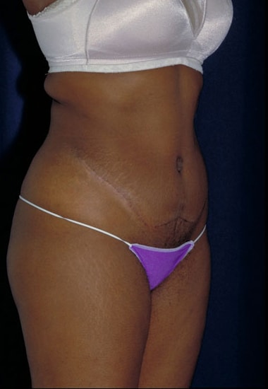 After Image: Tummy Tuck - right-front-oblique