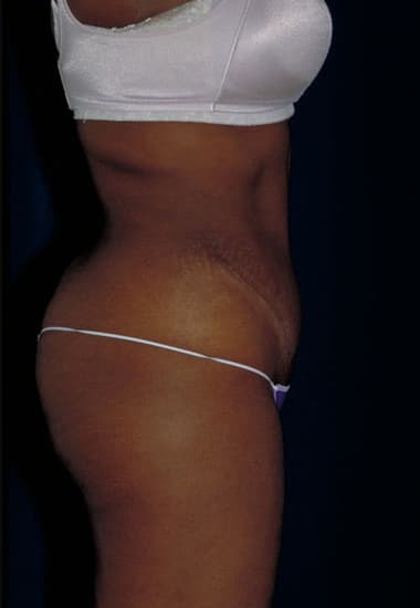 After Image: Tummy Tuck - right-side