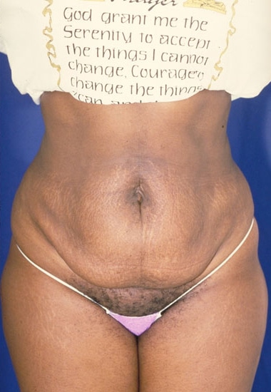 Before Image: Tummy Tuck - front