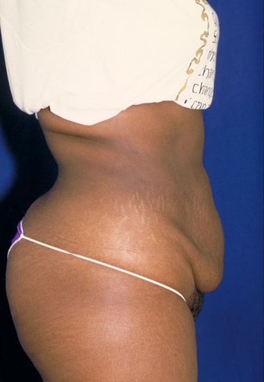 Before Image: Tummy Tuck - right-side