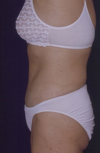 After Image: Tummy Tuck - front