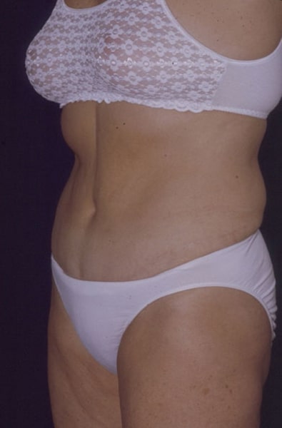 After Image: Tummy Tuck - left-front-oblique