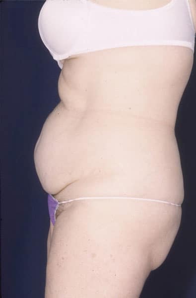 Before Image: Tummy Tuck - front