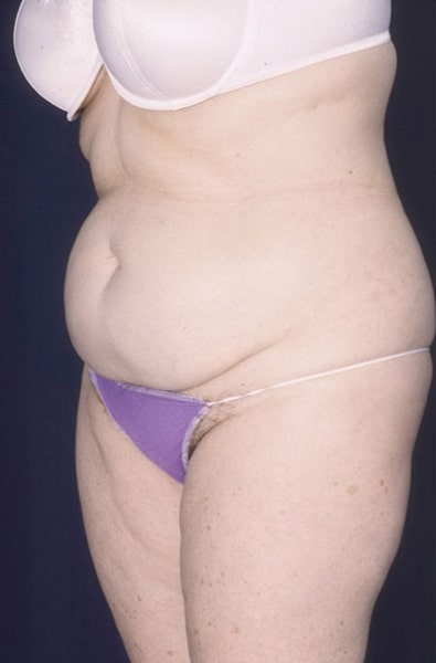 Before Image: Tummy Tuck - left-front-oblique