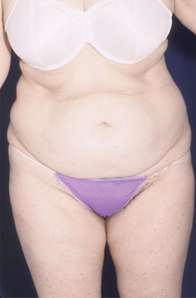 Before Image: Tummy Tuck - front