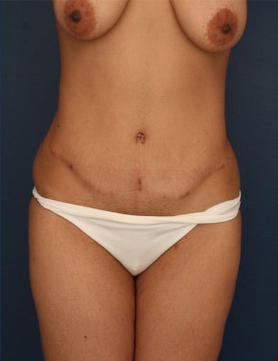 After Image: Tummy Tuck - front