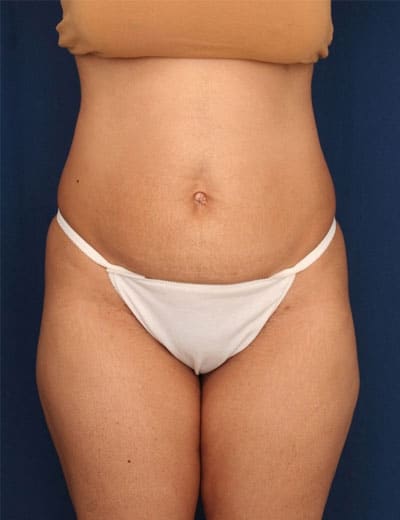 Before Image: Tummy Tuck - front
