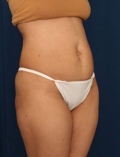 Before Image: Tummy Tuck - right-front-oblique