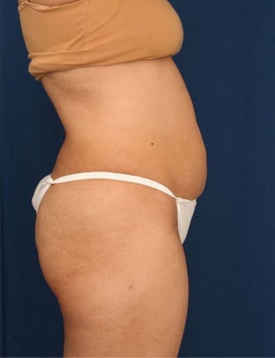 Before Image: Tummy Tuck - right-side