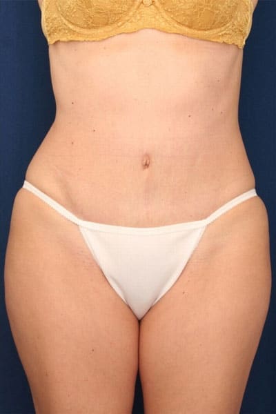 After Image: Tummy Tuck - front