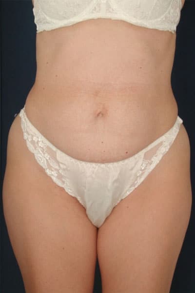 Before Image: Tummy Tuck - front