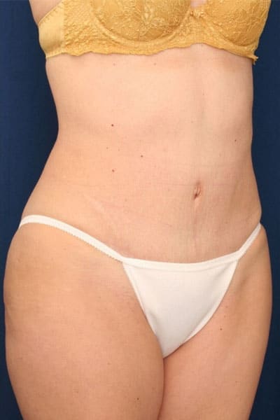 After Image: Tummy Tuck - right-front-oblique