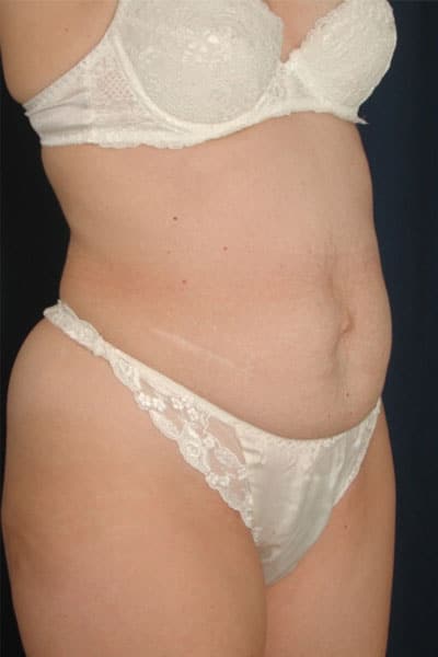 Before Image: Tummy Tuck - right-front-oblique