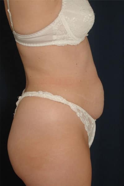 Before Image: Tummy Tuck - right-side
