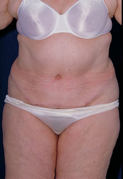 After Image: Tummy Tuck - front