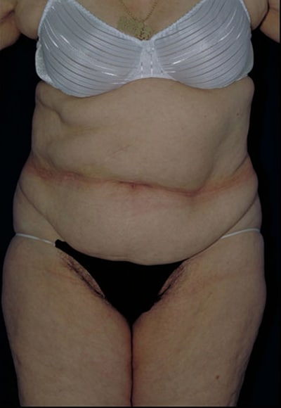 Before Image: Tummy Tuck - front