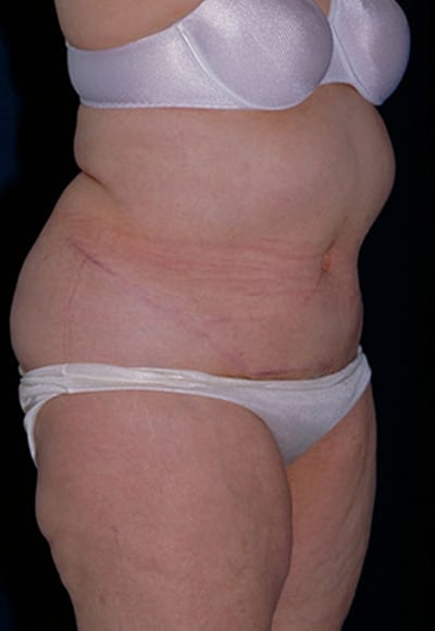 After Image: Tummy Tuck - right-front-oblique