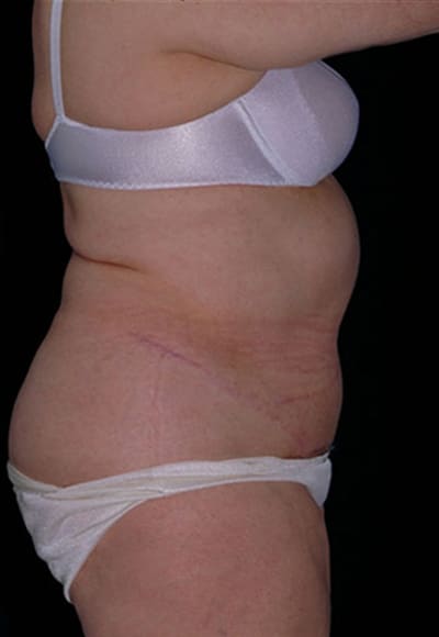 After Image: Tummy Tuck - right-side