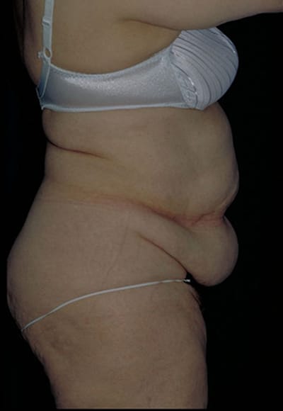Before Image: Tummy Tuck - right-side