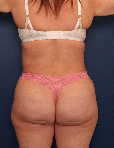 After Image: Tummy Tuck - back