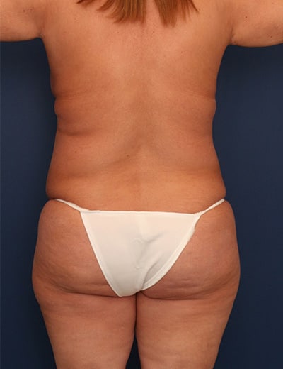 Before Image: Tummy Tuck - back
