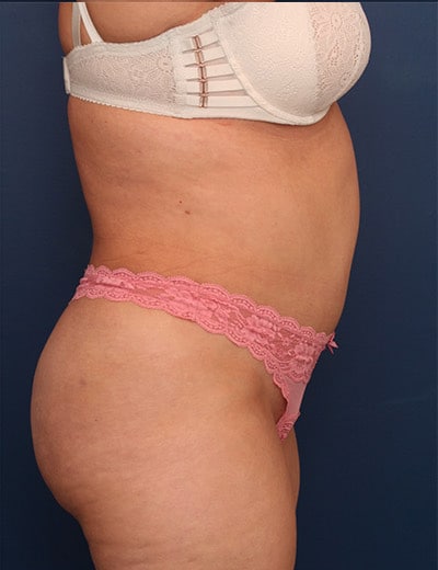After Image: Tummy Tuck - right-side