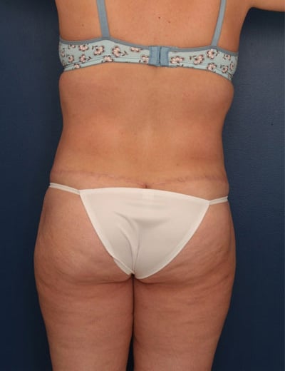 After Image: Tummy Tuck - back