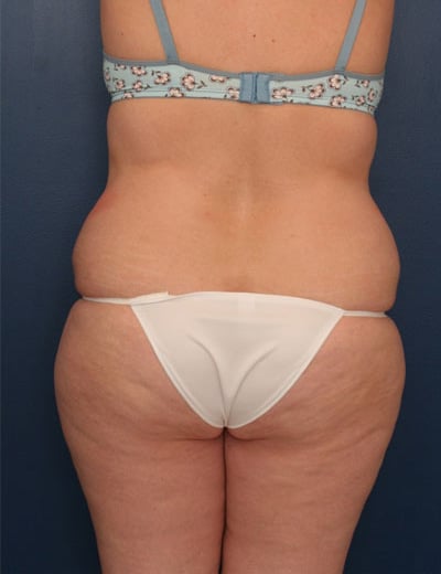 Before Image: Tummy Tuck - back