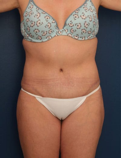 After Image: Tummy Tuck - front