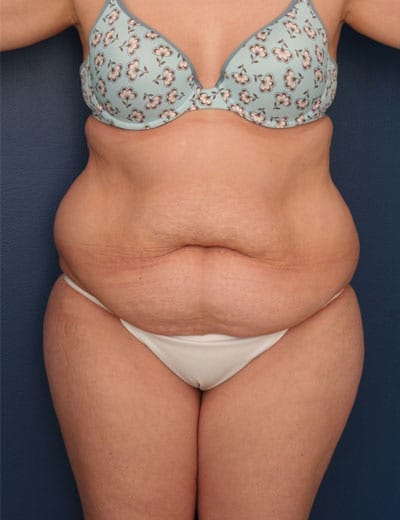 Before Image: Tummy Tuck - front