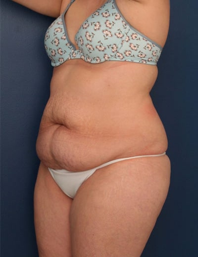 Before Image: Tummy Tuck - left-front-oblique
