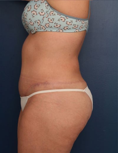After Image: Tummy Tuck - left-side