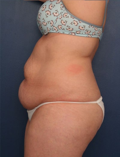Before Image: Tummy Tuck - left-side