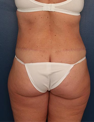 After Image: Tummy Tuck - back