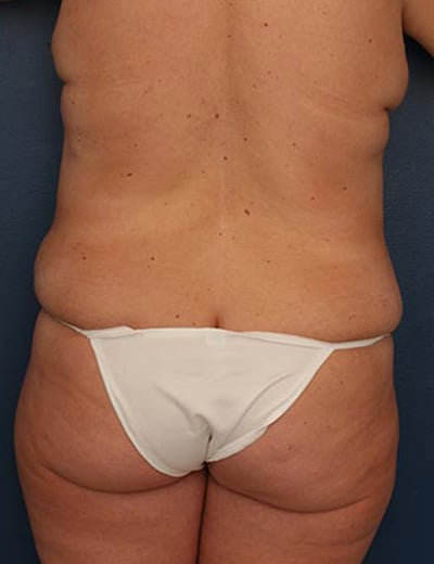 Before Image: Tummy Tuck - back