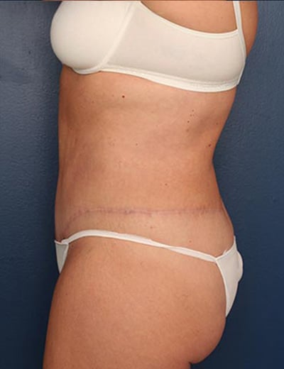 After Image: Tummy Tuck - left-side