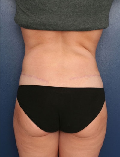 After Image: Tummy Tuck - back
