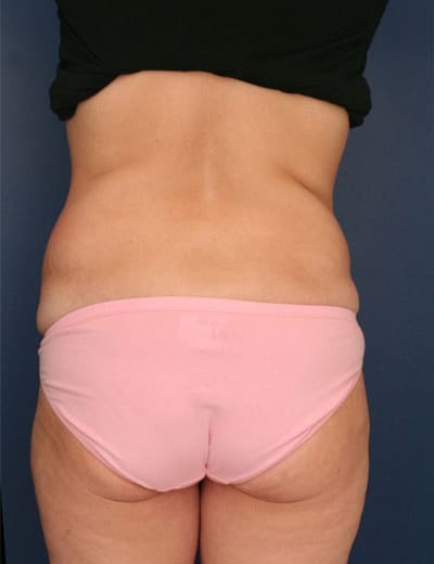 Before Image: Tummy Tuck - back