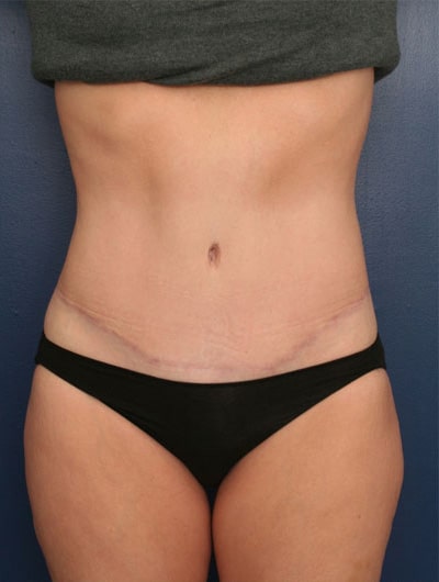 After Image: Tummy Tuck - front