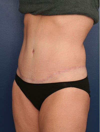 After Image: Tummy Tuck - left-front-oblique