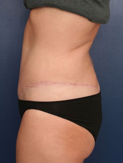 After Image: Tummy Tuck - left-side