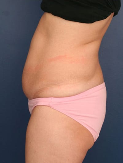 Before Image: Tummy Tuck - left-side