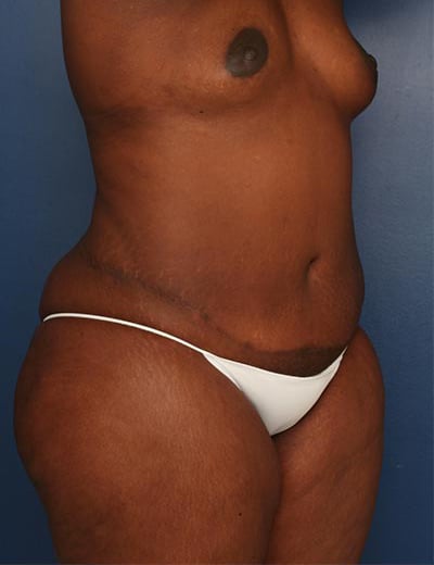 After Image: Tummy Tuck - right-front-oblique