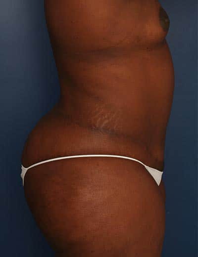 After Image: Tummy Tuck - right-side