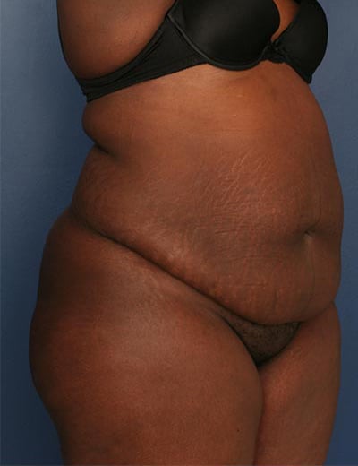 Before Image: Tummy Tuck - right-front-oblique