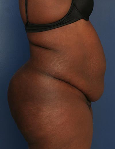 Before Image: Tummy Tuck - right-side